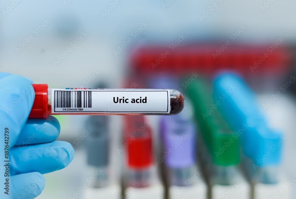 Fototapeta premium Blood sample tube for uric acid test analysis.