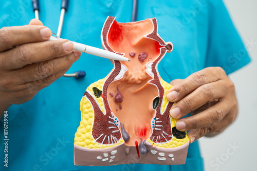 Slika na platnu Asian doctor with rectum and hemorrhoid human model, inflamed vascular structure