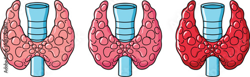 Thyroid gland anatomy illustration set showing normal and diseased thyroid conditions, endocrine health and medical education concept