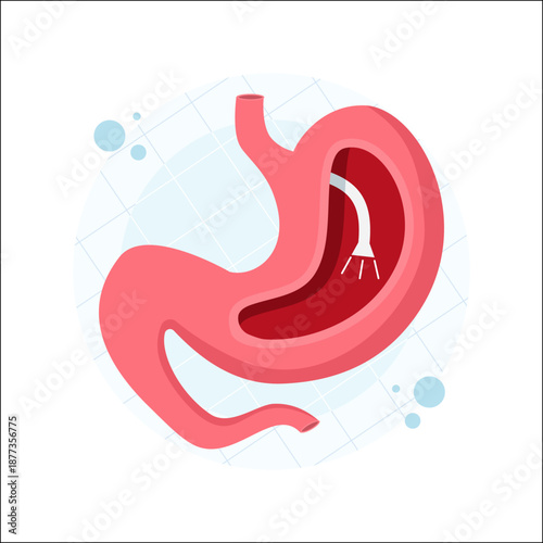 Illustration of a human stomach with gastric band surgery, representing bariatric treatment, weight loss procedure, and medical health concepts.