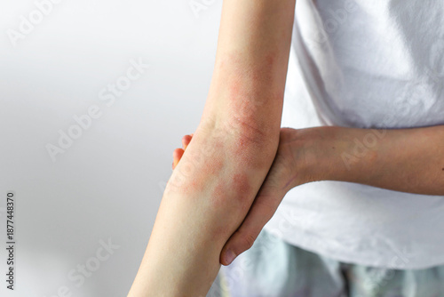 Photos Child forearm with visible eczema irritation red patches, sensitive dry skin aff