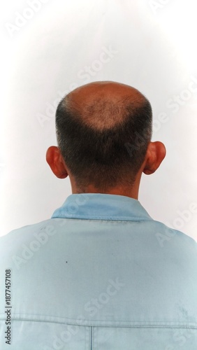 ​Close-up of Human Scalp Showing Hair Thinning and Alopecia, Back View of Man with Genetic Hair Loss Condition