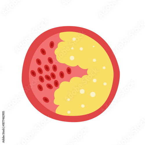 Cholesterol Buildup in Blood Vessel concept