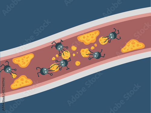 Nanobots clear cholesterol from an artery, illustrating a futuristic medical solution. Clean, modern illustration with vibrant colors and detailed design.