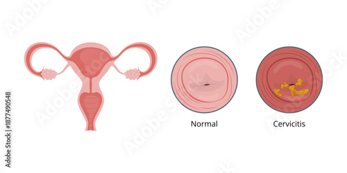 Cervicitis, inflammation of the cervix, and normal cervix comparison