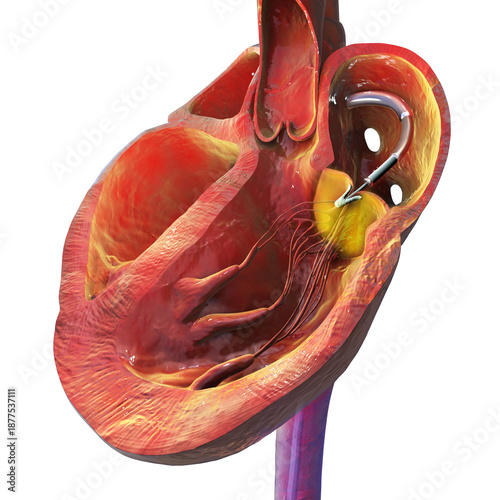 Fotografia Transcatheter edge-to-edge repair of the heart, illustration