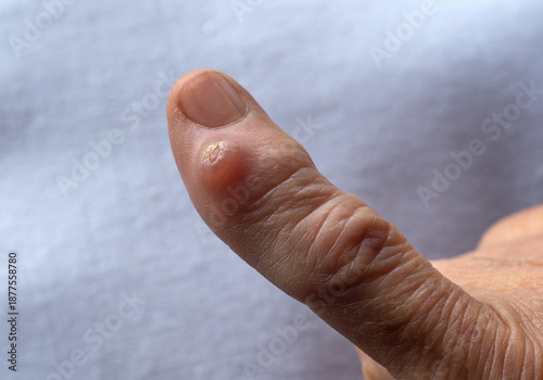 An excrescence on the finger of the hand.A wart on my finger.