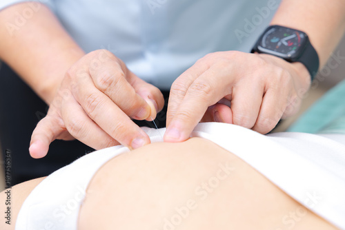 Konstfotografi Professional Doctor Doing Acupuncture Therapy on Patient Back for Pain Relief