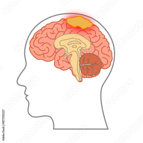 Illustration of meningioma. Tumor, cancer in the human brain. Illustration of brain disease. Flat Vector nerve illustration for medical concept, poster, diagram, science or health element infographic
