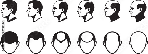 Baldness stages icon set with hair transplant and extensions in clean silhouette style.