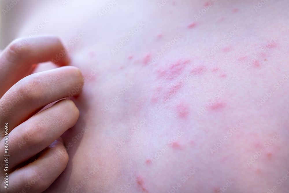 Fototapeta premium Preteen Child boy with red insect bug bites and rash on skin, scratching irritated skin, expressing mild pain, dermatology, rash treatment, allergic reaction, healthcare problem