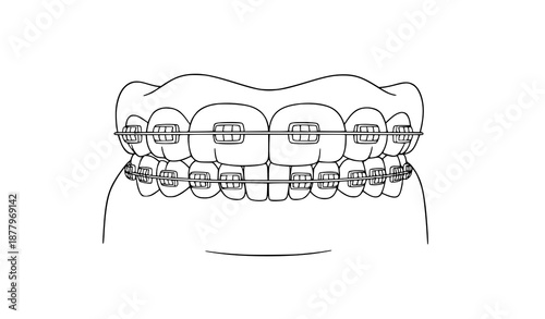 Teeth with Dental Braces Black and White Line Art Vector Illustration