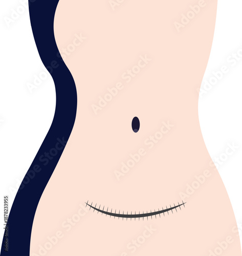 Cesarean Section Scar Illustration on Female Torso, Medical Recovery and Postpartum Health Concept for Motherhood
