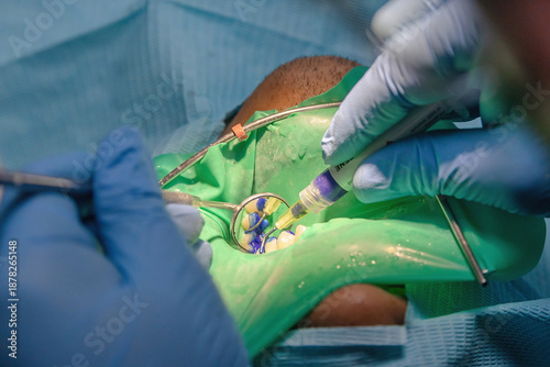 Fotografie Close-up of dental acid etching under rubber dam isolation