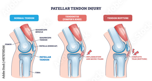 Patellar tendon injury visualizes normal, tendinitis, and rupture, focusing on patella, patellar tendon, and quadriceps to convey knee pain progression. Outline diagram
