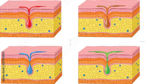 Stylized skin pore anatomy set, four cross-sectional variants with fluid types and conditions, dermatology concept, flat vector illustration