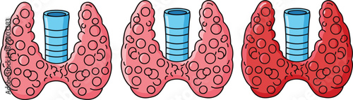 Thyroid gland anatomy, trachea structure, medical condition stages, goiter nodules, endocrine health concept, flat vector illustration, diagnostic reference image