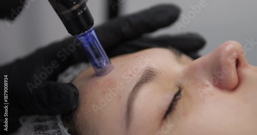 Cosmetic procedure microneedling. Teenage facial skin. Teenage facial skin care. Application of cosmetics and preparations.