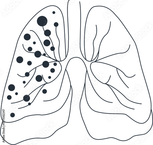 Lung with bronchial tree and metastasis  human anatomy