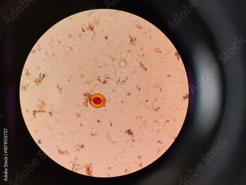 Microscopic view of Hymenolepis nana (dwarf tapeworm) eggs in a fecal specimen, diagnostic of hymenolepiasis. 