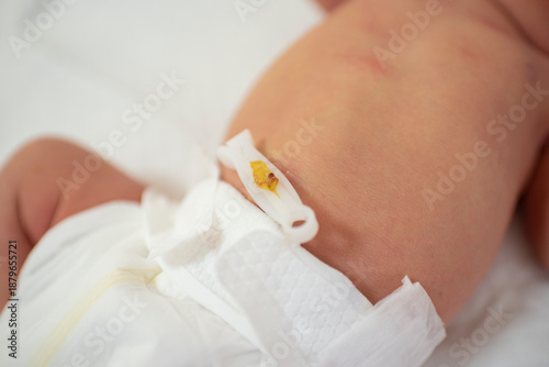 Tableau sur toile baby's belly, a disposable sterile umbilical clamp on the navel, the baby is 1 day old