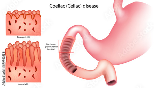 Celiac disease: immune-mediated damage of the small intestinal mucosa characterized by villous atrophy and impaired nutrient absorption.