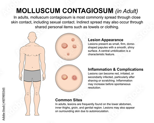 Molluscum Contagiosum in adult flashcard