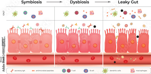 The Journey from Gut Symbiosis to Dysbiosis and Leaky Gut Syndrome