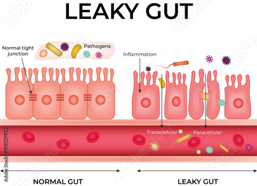Leaky Gut Syndrome Normal vs Inflamed Intestinal Barrier Design