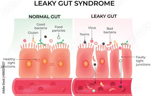 Leaky Gut Syndrome Normal vs Faulty Intestinal Barrier