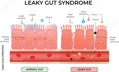 Leaky Gut Syndrome: Visualising Intestinal Permeability and Gut Health