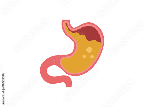 GERD Gastroesophageal Reflux Disease in Stomach