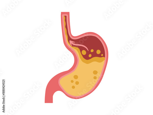 GERD Gastroesophageal Reflux Disease in Stomach