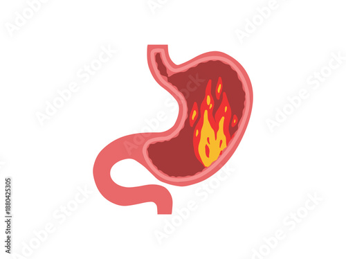 Stomach Burning or Heartburn Disease