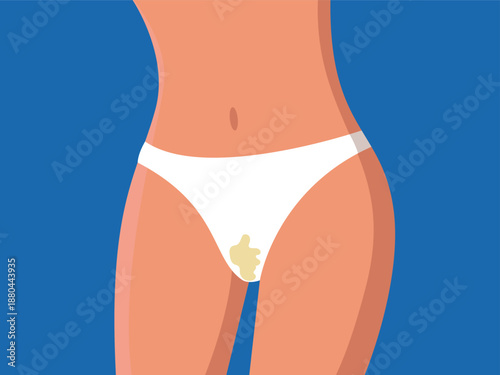 Vaginal iifection concept, woman white vaginal discharge on panty