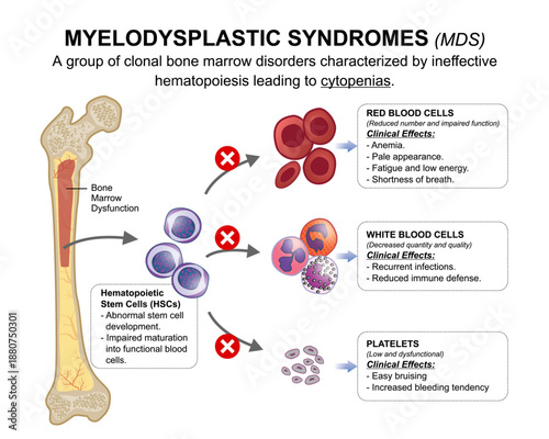 Myelodysplastic Syndromes (MDS) Medical Flashcard