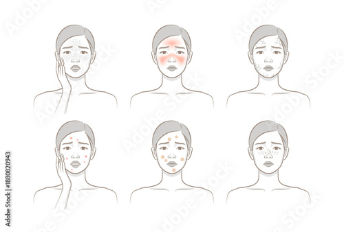 Various female facial skin problems including acne, redness, dryness, freckles and irritation skin conditions.