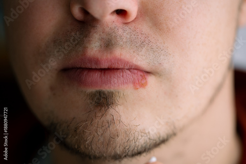 Photos Young man having herpes simplex virus outbreak, presenting a cold sore or fever