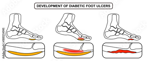 Development of diabetic foot ulcers. Superficial callus formation, pressure on the foot, inflammation and bleeding, ulcer expansion, deep ulcer. Line drawing Vector for medical, clinic and poster