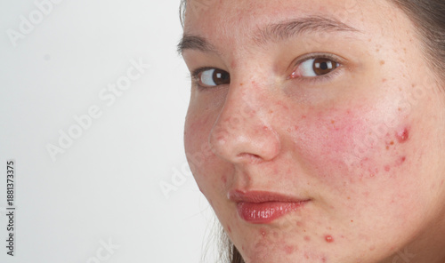 Obraz na plátne Pimple acne on young woman face close up