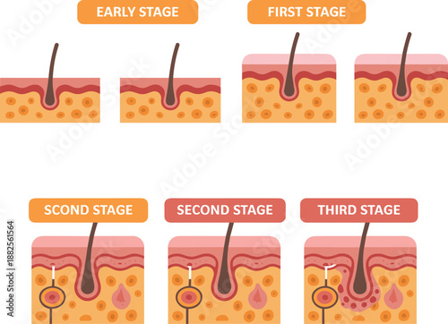 Anatomy Of Hair Growth Cycle Stages Infographic Showing Early First Second And Third Stage Of Follicle Development In Human Skin