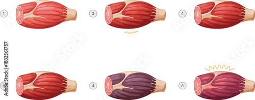 Anatomy of Skeletal Muscle Tissue Showing Different Stages of Contraction Tension Discoloration and Inflammation for Medical Education and Healthcare Graphic Design