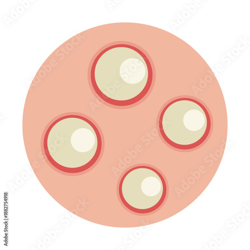 monkey pox, Mpox disease skin symptom concept
