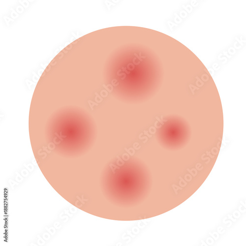 monkey pox, Mpox disease skin symptom concept