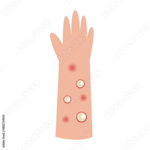 monkey pox, Mpox disease skin symptom concept