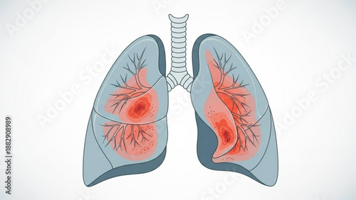 Human lungs with inflamed damaged areas respiratory illness concept medical illustration