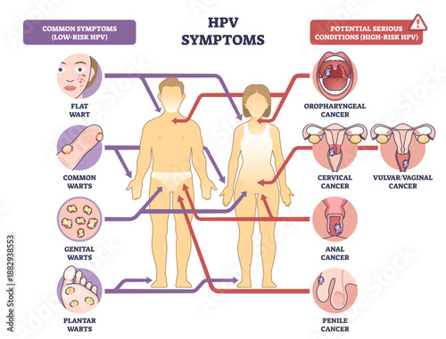 HPV symptoms diagram shows male and female silhouettes with arrows linking warts and cancer sites, key objects, human bodies, wart icons, reproductive organs. Outline diagram