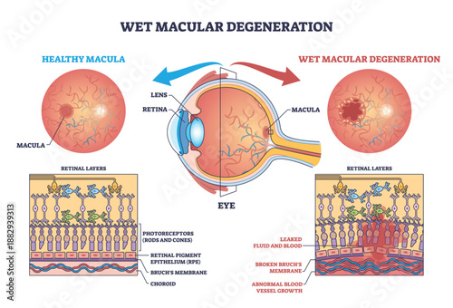 Wet macular degeneration shown in a brief eye cross-section comparing healthy and diseased macula, retina and abnormal blood vessels depict leakage causing central vision loss. Outline diagram