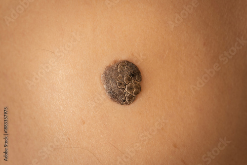 Photos Pigmented skin lesion developing on human skin, resembling a seborrheic keratosi