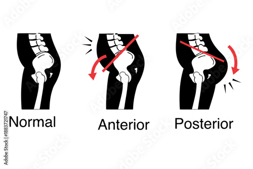 Anterior and Posterior Pelvic Tilt Posture Comparison Black Silhouette